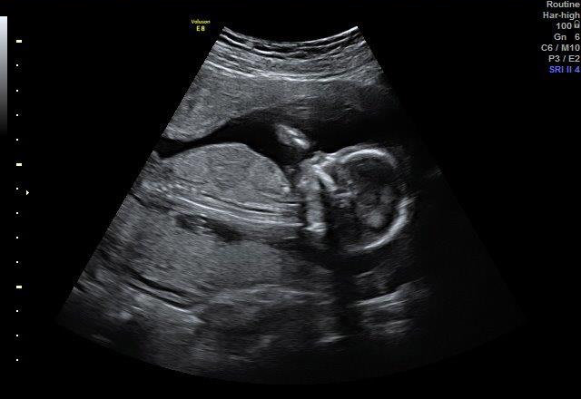 17-WEEKS 3