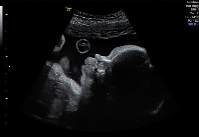 31-WEEKS 3